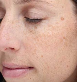 Sun spots freckles