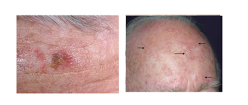 Actinic Keratosis