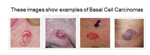 Basal Cell Carinomas website 