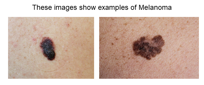 Examples of Melanoma website 