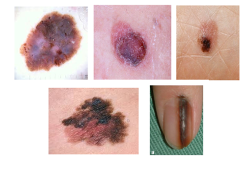 Malignant Melanoma