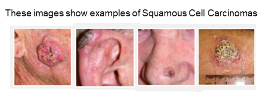 Squamous Cell Carinomas website 